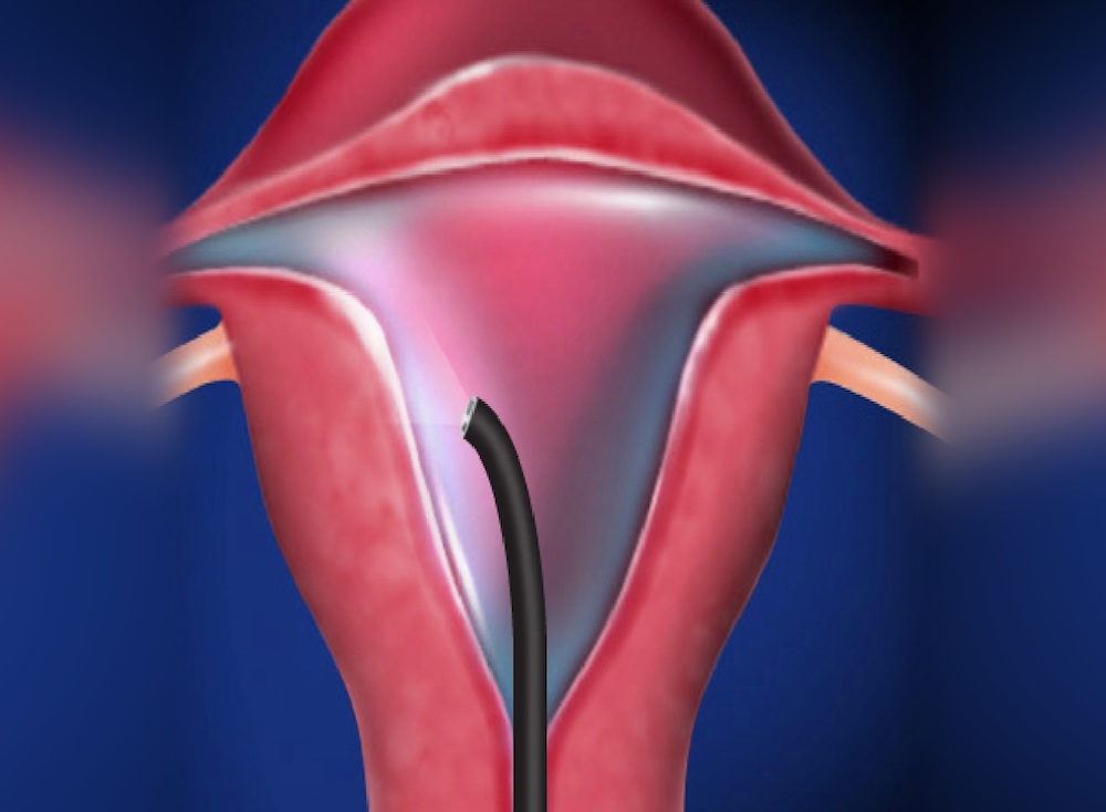 Differenza tra Steroscopia e isterosalpingografia