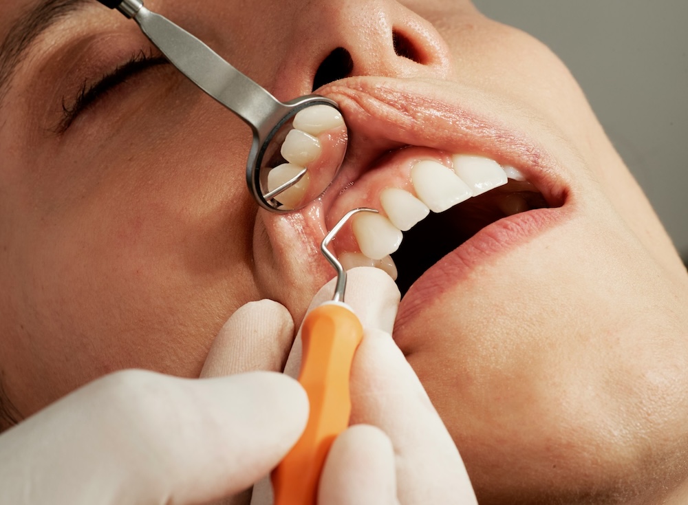 Posso togliere il dente del giudizio in gravidanza?